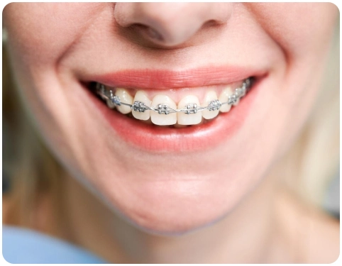 Risoarte Dentista, aparelho ortodôntico no Cambuci e Mooca-SP