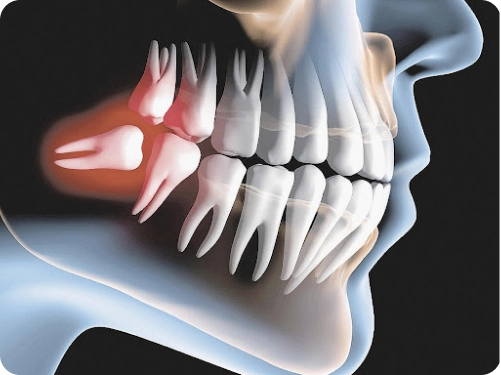 Tipos de Cirurgias Dentárias - Risoarte Dentista no Cambuci e Mooca-SP