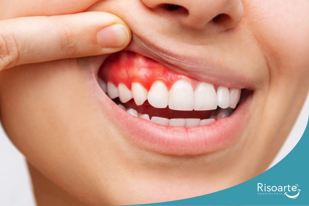 Gengiva sangrando durante a escovação indicando possível problema periodontal na Mooca