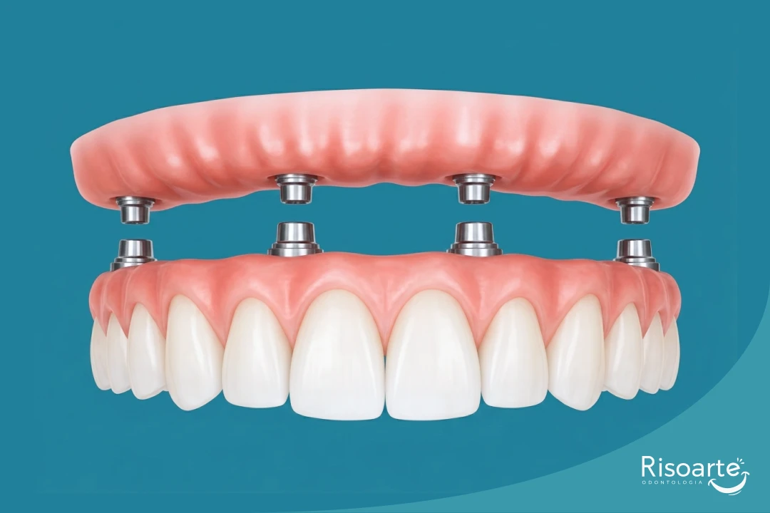 Prótese protocolo com dentes fixos sobre implantes na Clínica Odontológica Risoarte na Mooca