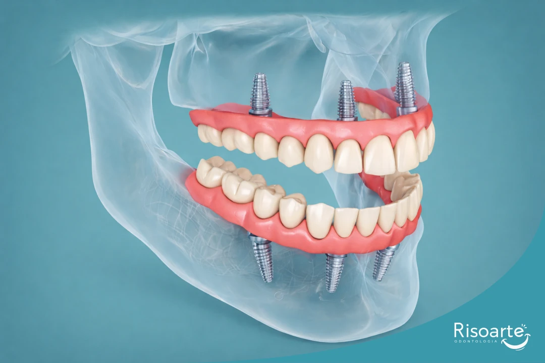 Etapas do implante dentário com prótese sobre implantes em clínica na Mooca, Risoarte Odontologia.