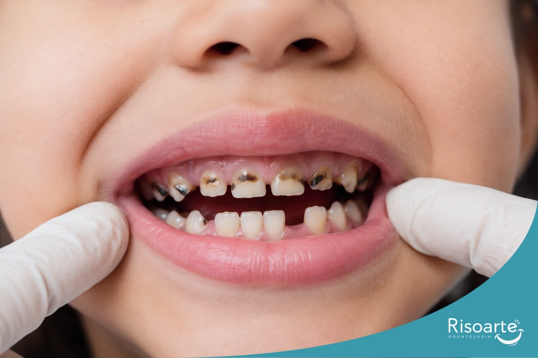 Criança com vários dentes de leite comprometidos por cáries durante avaliação odontopediátrica.