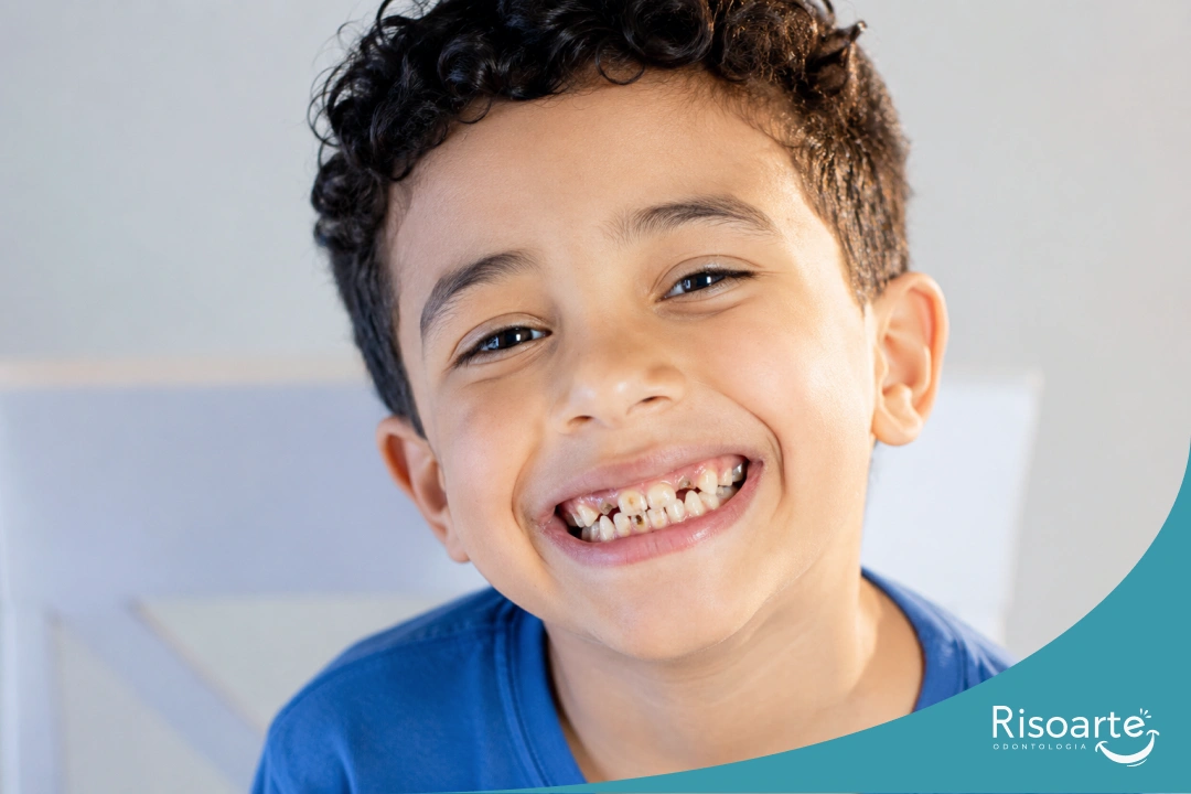 Criança sorrindo com dentes de leite escurecidos e manchas escuras que podem indicar cárie.
