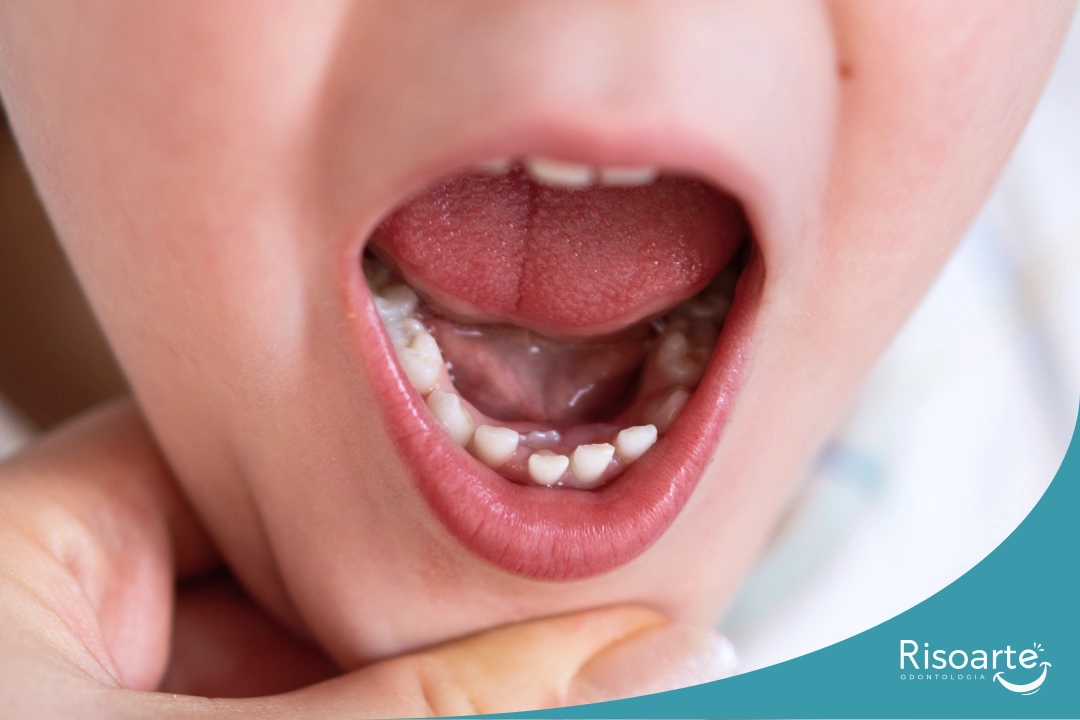 Dente permanente nascendo atrás do dente de leite em criança