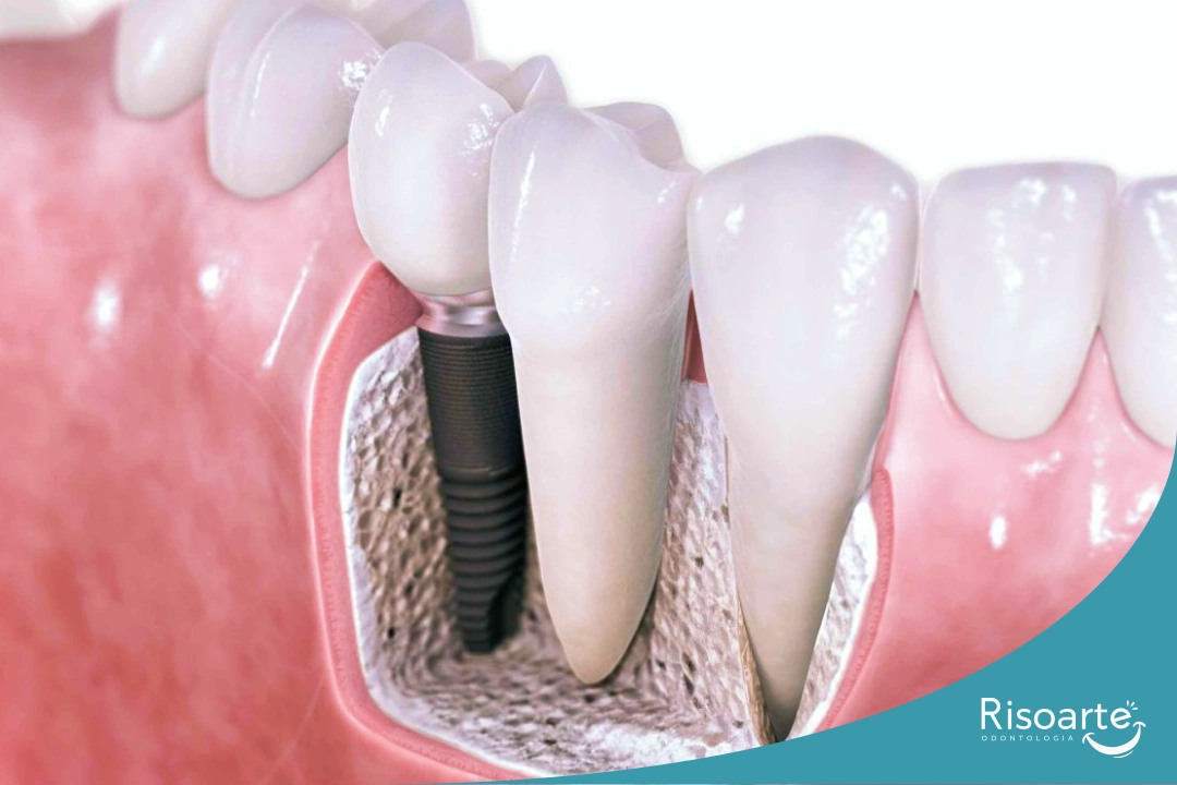Enxerto ósseo para implante dentário
