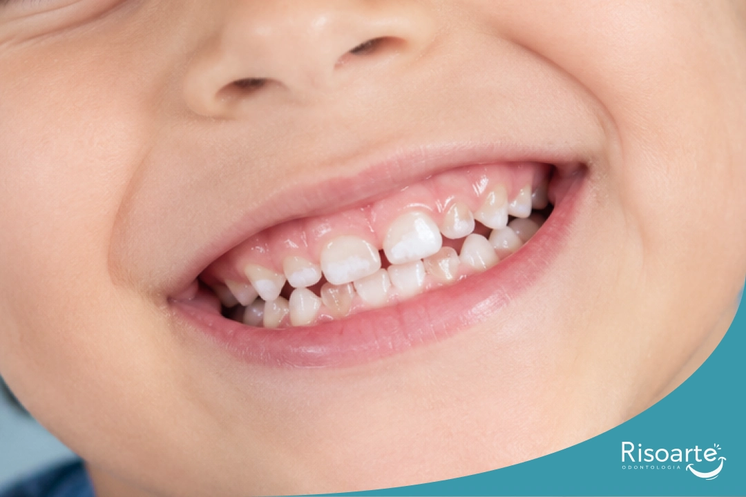 Mancha branca nos dentes de criança
