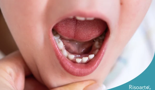 Dente permanente nascendo atrás do dente de leite em criança