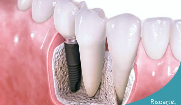 Enxerto ósseo para implante dentário