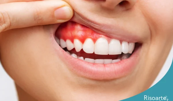 Gengiva sangrando durante a escovação indicando possível problema periodontal na Mooca