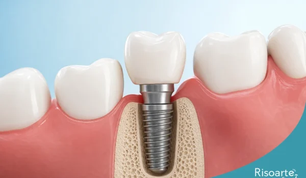 Implante dentário com coroa para reabilitação oral em clínica na Mooca