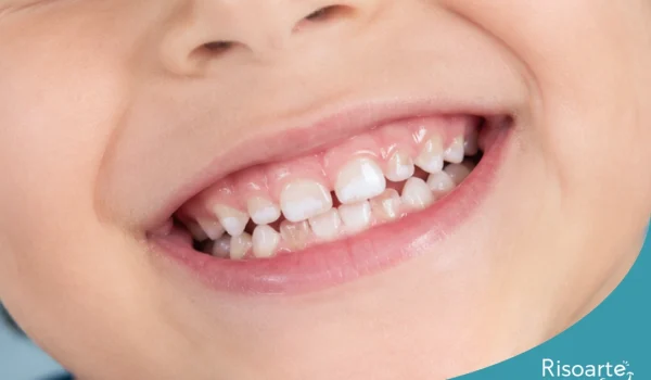 Mancha branca nos dentes de criança
