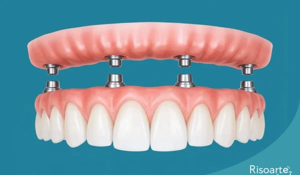 Prótese protocolo com dentes fixos sobre implantes na Clínica Odontológica Risoarte na Mooca