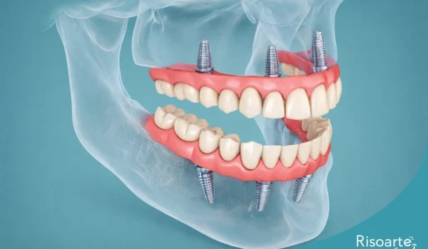 Etapas do implante dentário com prótese sobre implantes em clínica na Mooca, Risoarte Odontologia.